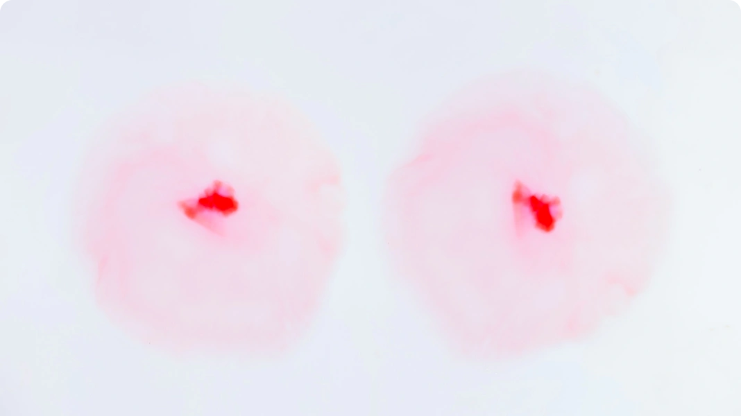 Illustration showing a cross-section of a breast with fluid leaking from the nipple, representing nipple discharge.