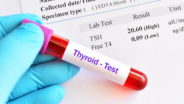 Gloved hand holding a blood sample tube labeled over a lab report with thyroid hormone results.