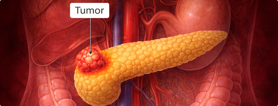 Human body showing highlighted pancreas.