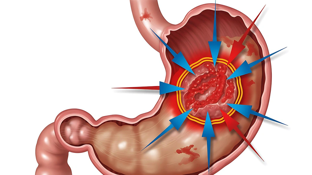 Graphic of inflamed stomach lining.