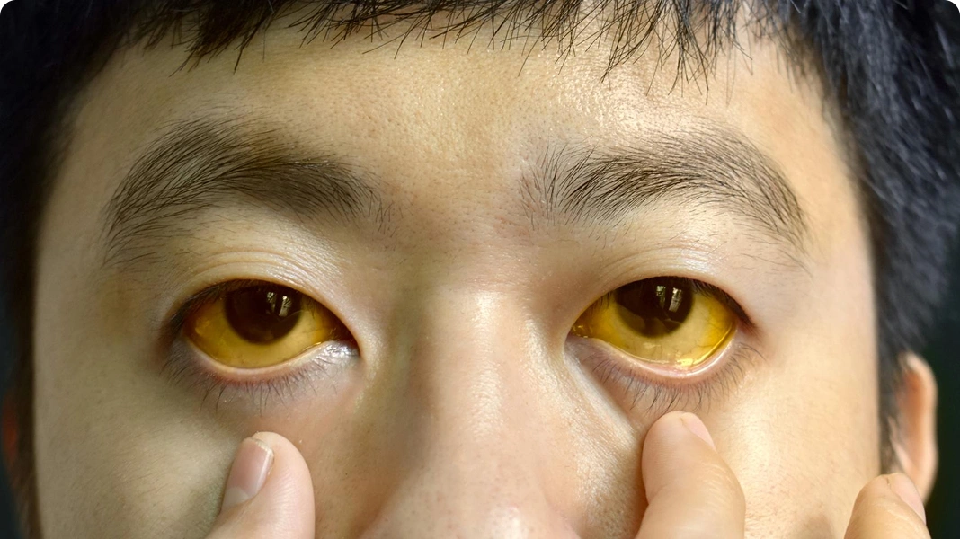 Close-up of yellowing eyes due to jaundice.