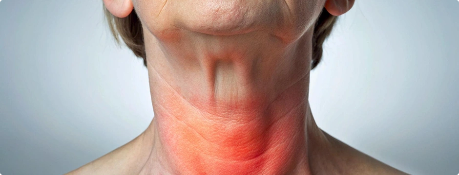 Close-up of a swollen neck, possibly indicating a thyroid goiter.